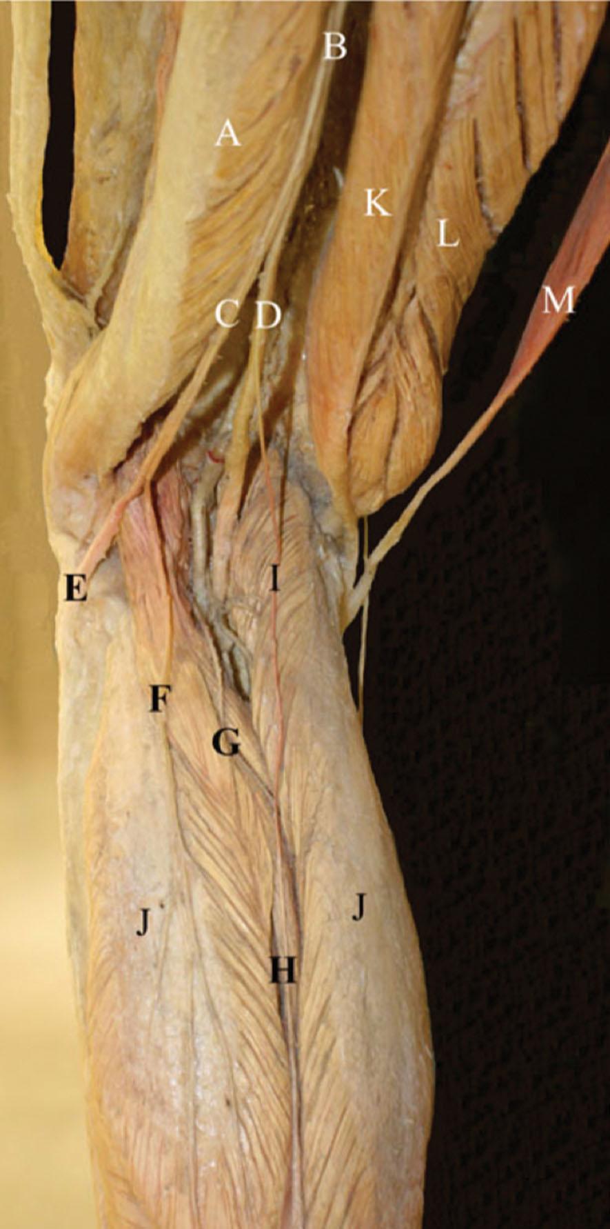 Figure 30.2, Dissection of the posterior thigh and calf. A = Biceps femoris muscle; B = sciatic nerve; C = peroneal (fibular) division; D = tibial division; E = common peroneal (fibular) nerve; F = lateral sural cutaneous nerve; G = sural communicating branch; H = sural nerve; I = medial sural nerve; J = gastrocnemius muscle; K = semitendinosus muscle; L = semimembranosus muscle; M = gracilis muscle.