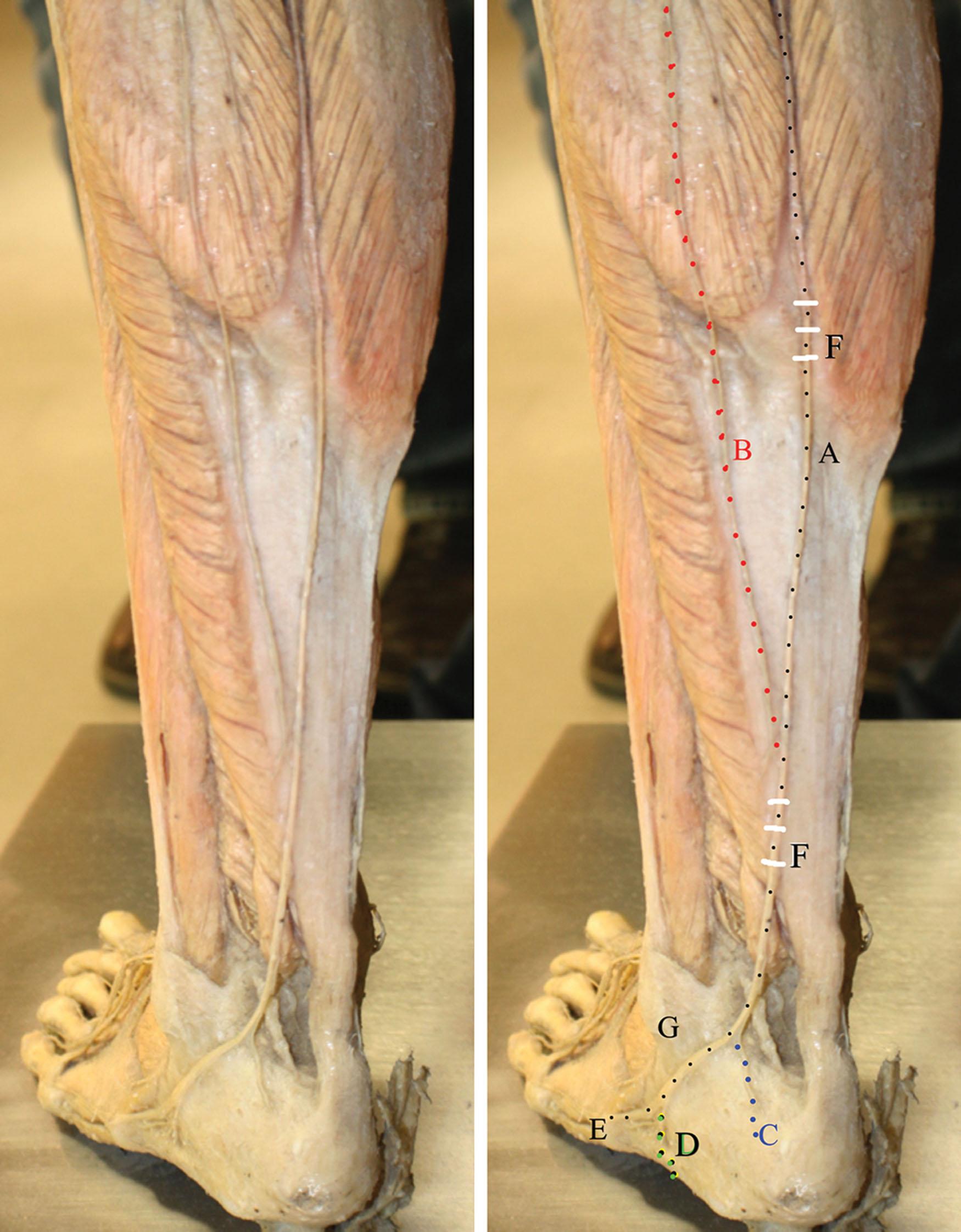 Figure 30.3, Dissection of the posterior calf and heel. A (black) = Sural nerve; B (red) = lateral sural cutaneous nerve; C (blue) = posterior calcaneal nerve; D (green) = lateral calcaneal nerve; E = lateral tuberosity of the fifth metatarsal; F = (white) fibrous arcade; G = lateral malleolus.