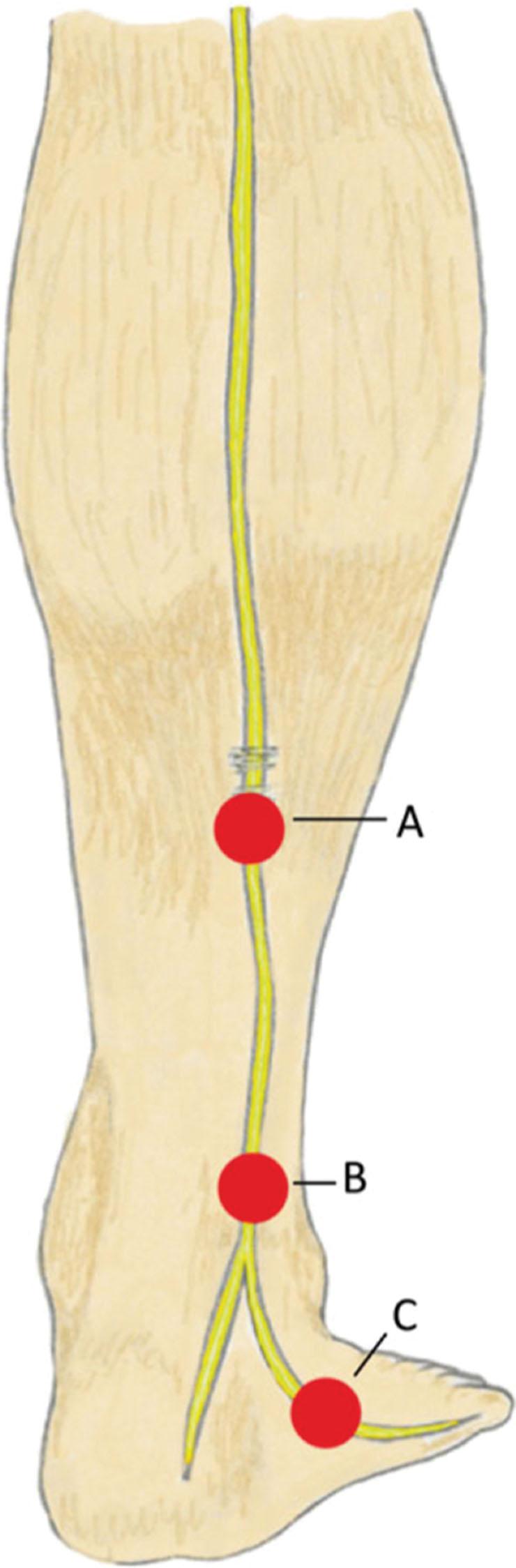Figure 30.4, Sites of entrapment of the sural nerve. A = Midcalf between the heads of gastrocnemius; B = fibrous arcade superficial to the Achilles tendon; C = lateral foot.