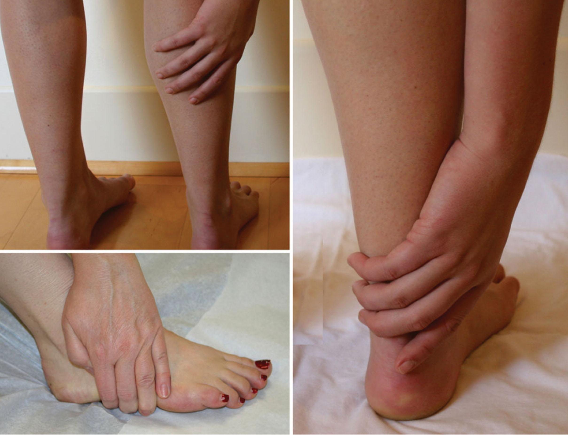 Figure 30.5, Patient pain complaint from sural nerve entrapment.