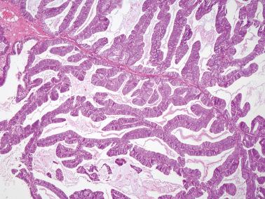 Fig. 14.11, Endometrioid borderline tumor. A higher-power view of Fig. 14.10 .