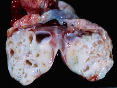 Fig. 14.2, Endometrioid adenofibroma. The tumor has a predominantly solid white sectioned surface with scattered cysts.