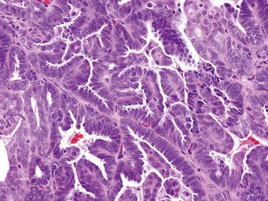 Fig. 14.24, Endometrioid adenocarcinoma, papillary pattern. The cytologic atypia is less striking than would be expected in a serous papillary carcinoma.