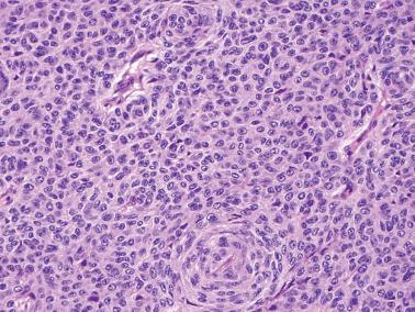 Fig. 14.33, Endometrioid adenocarcinoma with solid granulosa like pattern. A whorl at the bottom center is suggestive of abortive squamous differentiation, a helpful finding in many cases of this type.
