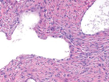 Fig. 14.54, Clear cell adenofibroma. The presence of cells with limited clear cytoplasm lining some glands is a helpful diagnostic aid.