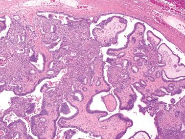 Fig. 14.8, Atypical endometrioid papillary cystadenoma. A high-power view of the prior figure shows prominent squamous metaplasia.