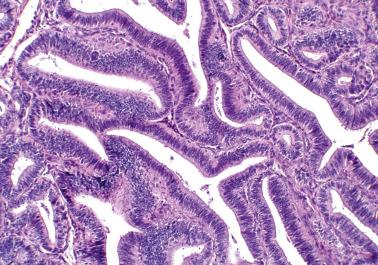 Fig. 14.9, Borderline endometrioid tumor. There is a complex pattern with focal cytologic atypia, the latter not clearly seen at this magnification.