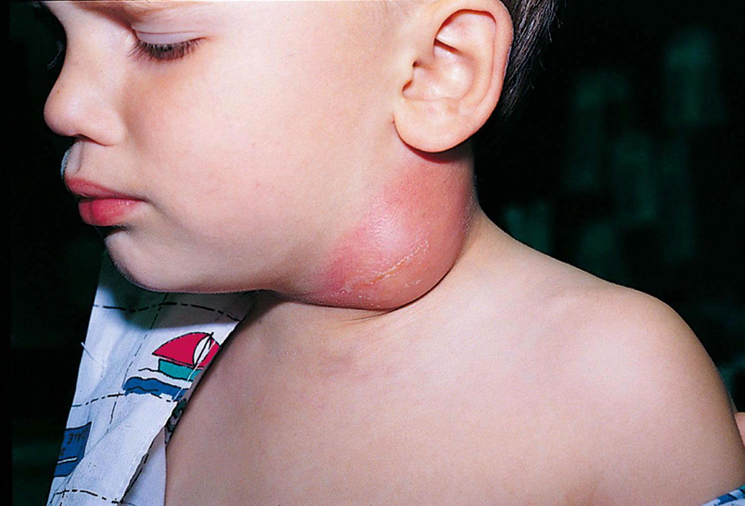 Fig. 18.1, Erythema and fluctuance identify the presence of an abscess. An abscess may be present without fluctuance, however, as the result of induration from surrounding inflammation.