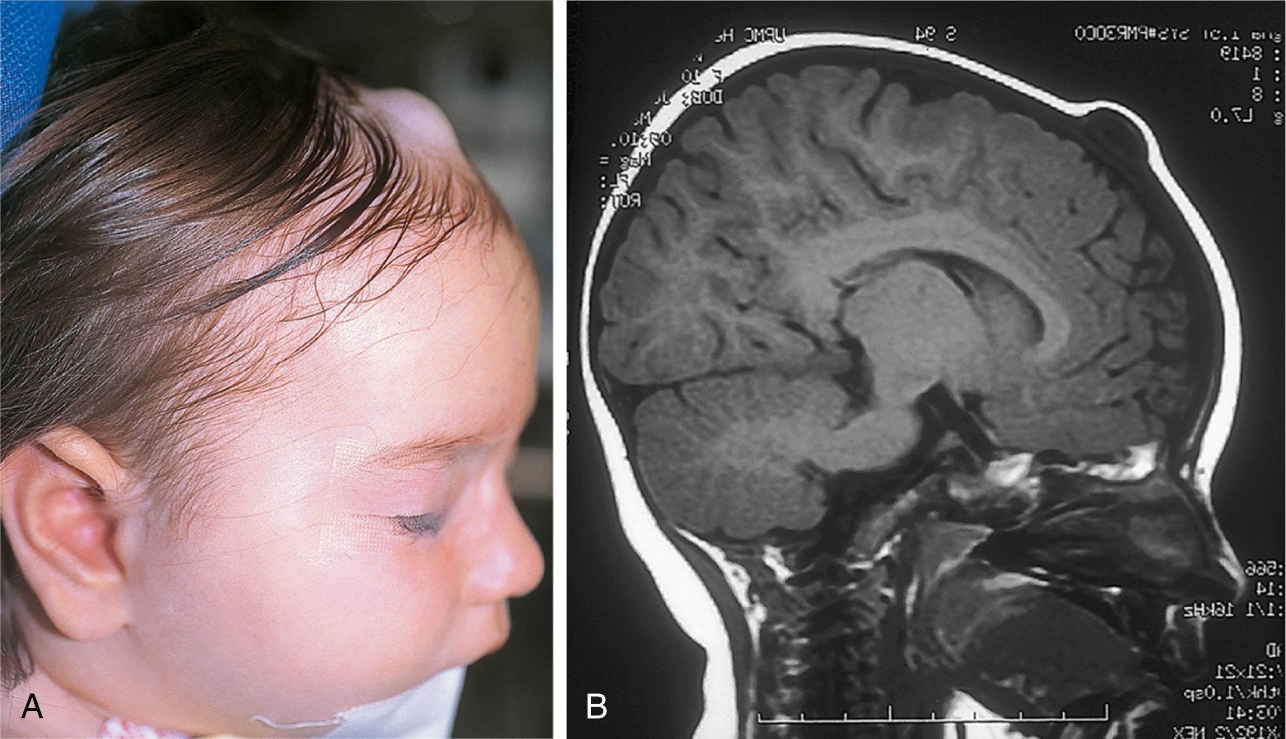 Fig. 18.11, (A) Midline scalp dermoid cysts may have intracranial extension and should always be evaluated by magnetic resonance imaging before surgery. (B) The dermoid in this 2-year-old child extends to but not through the dura.