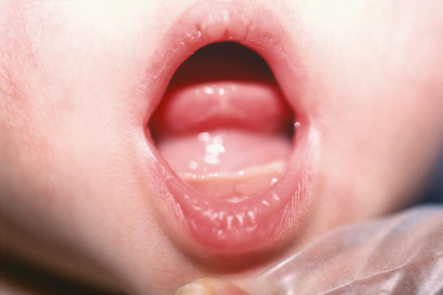 Fig. 18.12, A ranula arises in the floor of the mouth, caused by congenital obstruction of the sublingual duct.