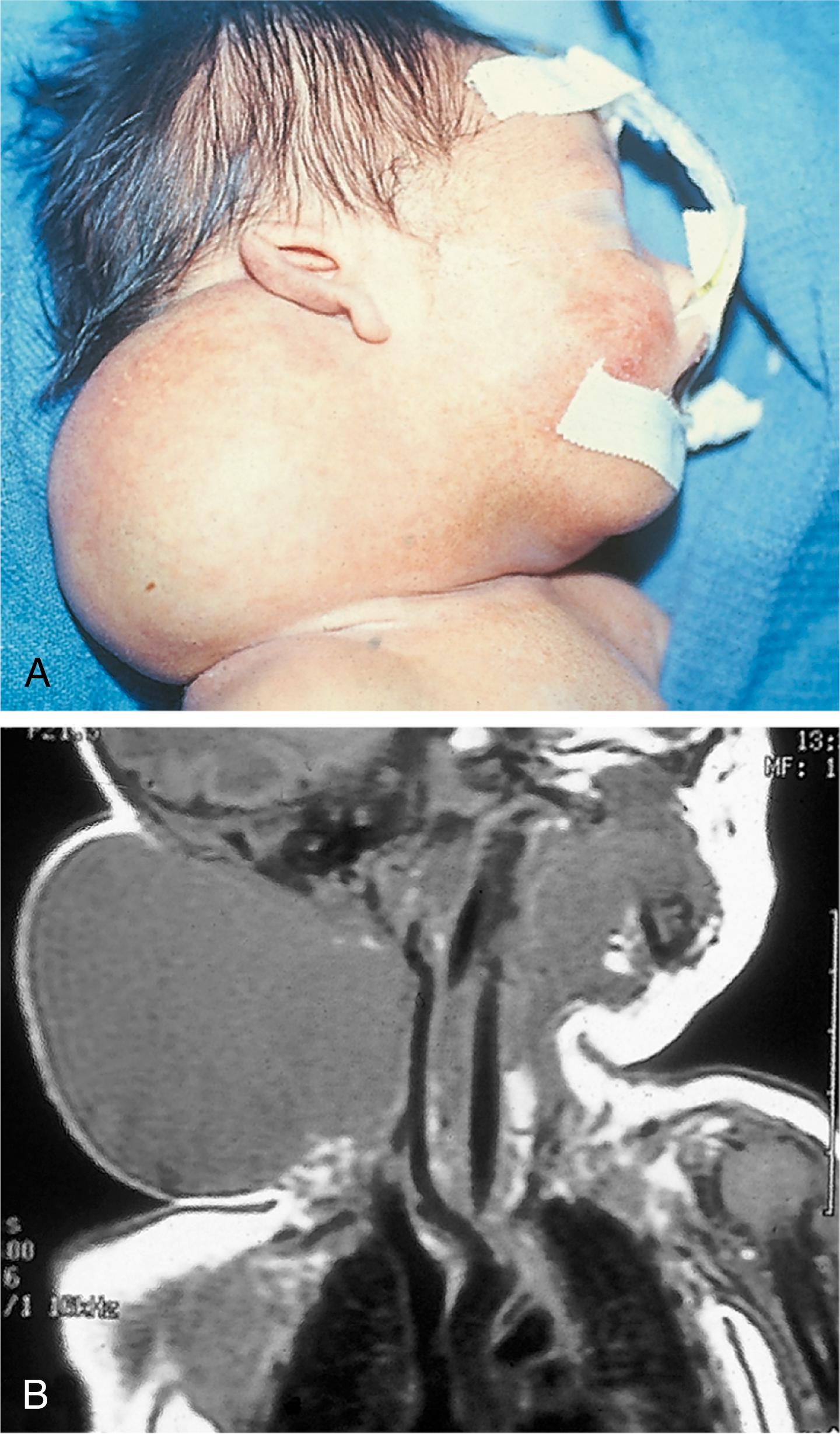 Fig. 18.13, (A) Cervical cystic hygroma. (B) Magnetic resonance imaging demonstrates its juxtaposition to the airway structures and vessels in the neck. Acute enlargement at birth secondary to hemorrhage may lead to airway compression.