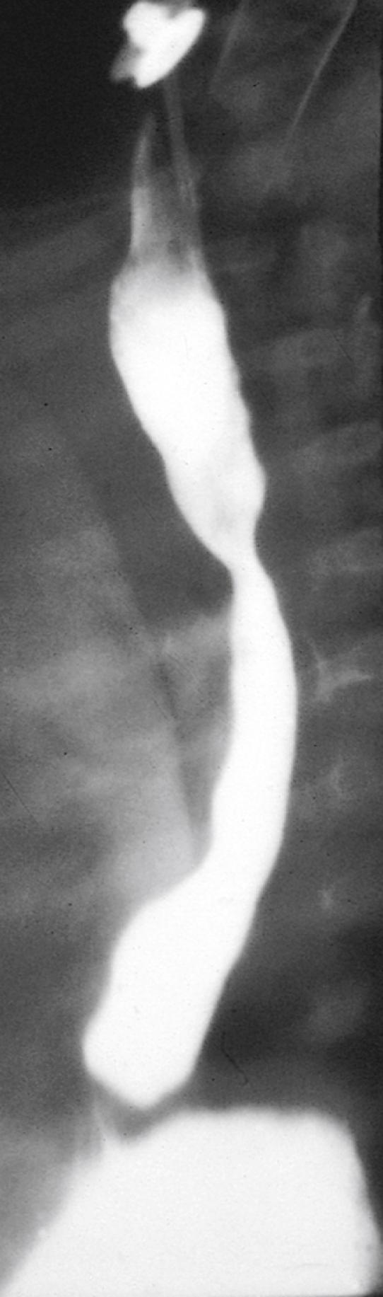 Fig. 18.14, Midthoracic compressions into the esophageal barium column identify the presence of vascular ring anomalies (in this case, pulmonary artery sling).