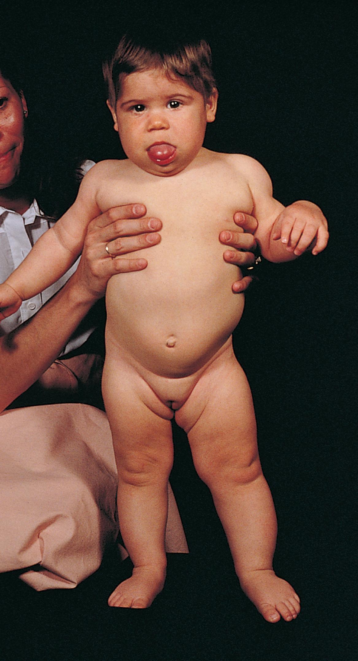 Fig. 18.15, Beckwith-Wiedemann syndrome. Note hemihypertrophy on the left side, along with the prominence of the tongue.