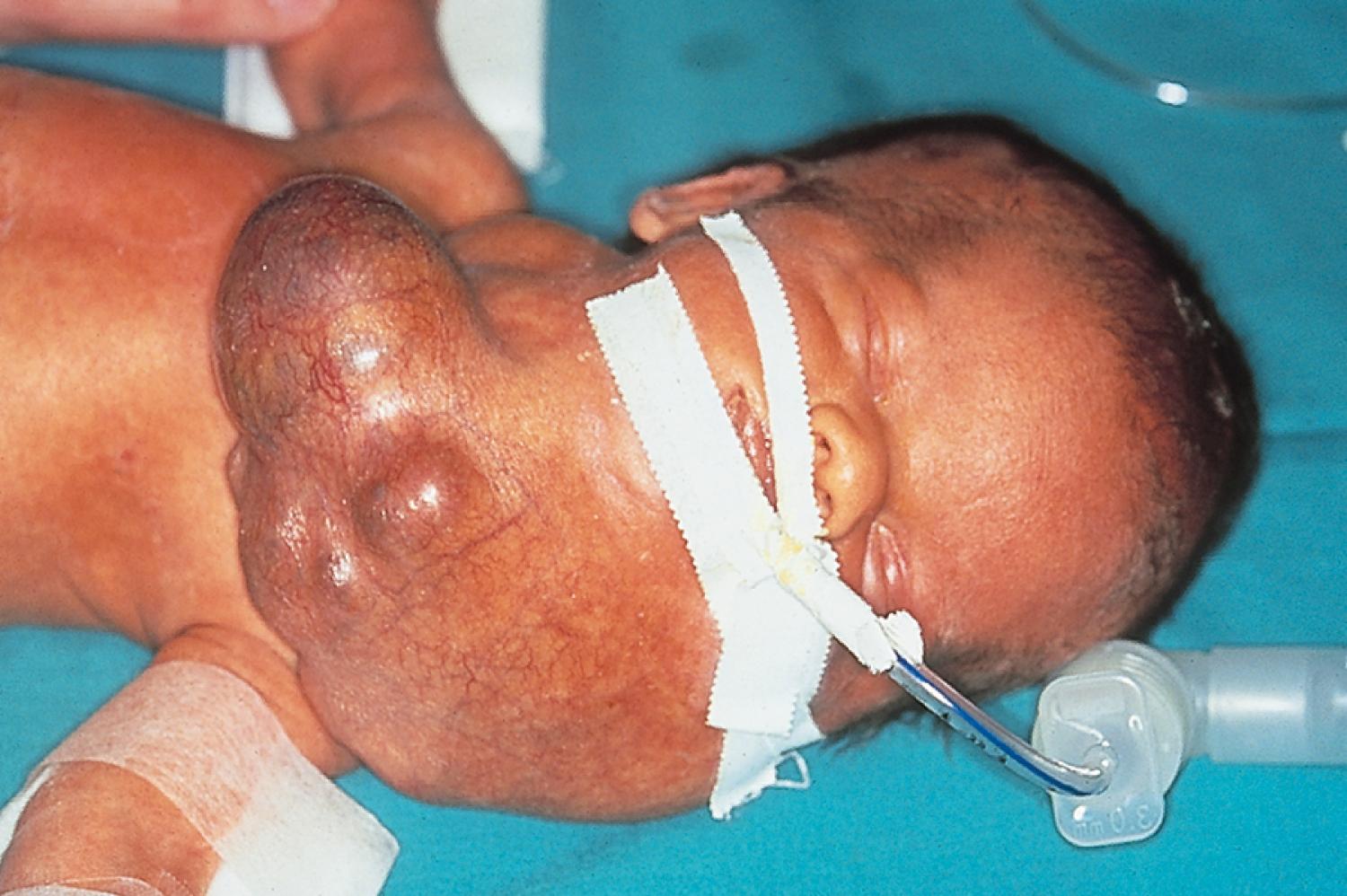 Fig. 18.17, Large cervical masses like this cervical teratoma diagnosed by antenatal ultrasonography cause prenatal esophageal compression and polyhydramnios. Because of the high risk of upper airway compression at delivery, an ex utero intrapartum treatment procedure is indicated to avoid infant death.