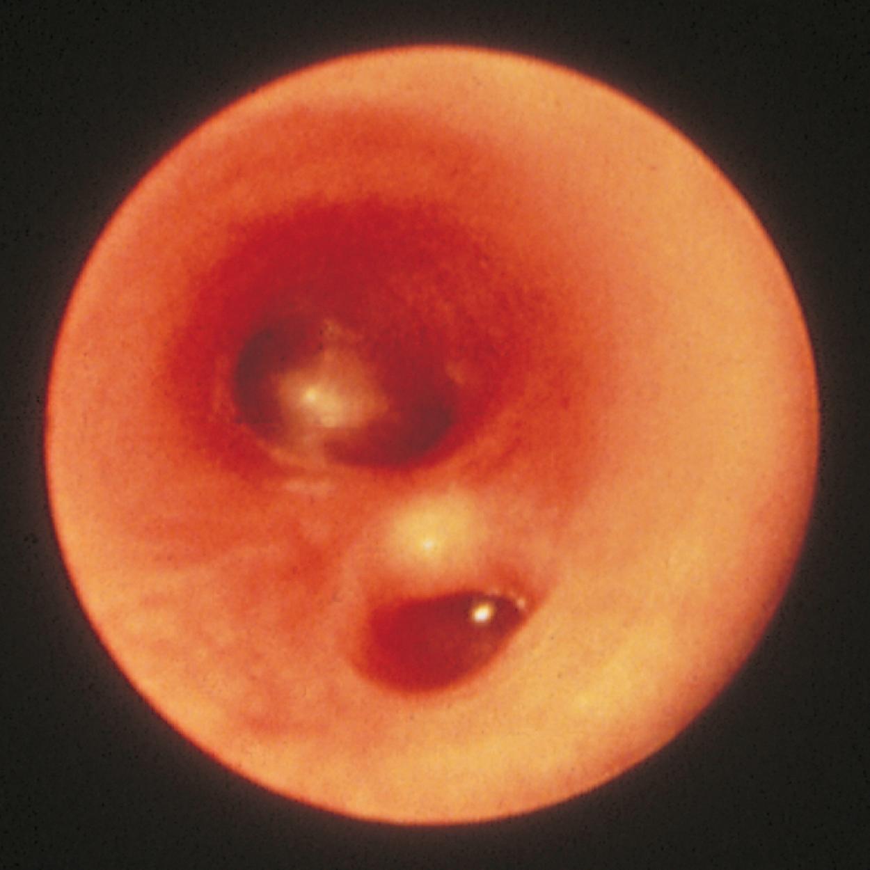 Fig. 18.18, Bronchoscopy visualizes a tracheoesophageal fistula, seen as a posteriorly positioned orifice (bottom) in the upper trachea. The carina, seen toward the top of the picture, lies distally.