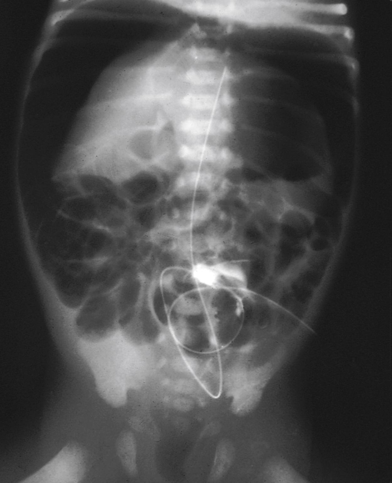 Fig. 18.19, Tracheoesophageal fistula allows air to be forced into the stomach during positive-pressure ventilation by bag and mask or through an endotracheal tube. The stomach may perforate as shown in this patient with a pneumoperitoneum, or ventilation may become suddenly ineffective if a gastrotomy is placed initially during surgical repair.