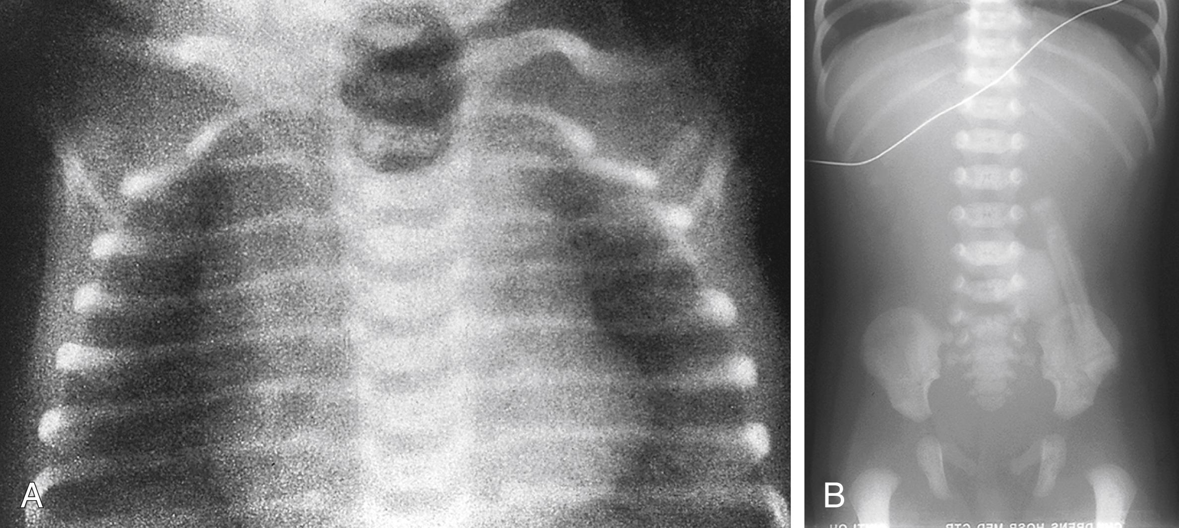 Fig. 18.20, A dilated blind proximal esophageal pouch (A) and a gasless abdomen (B) are the radiographic hallmarks of pure esophageal atresia.