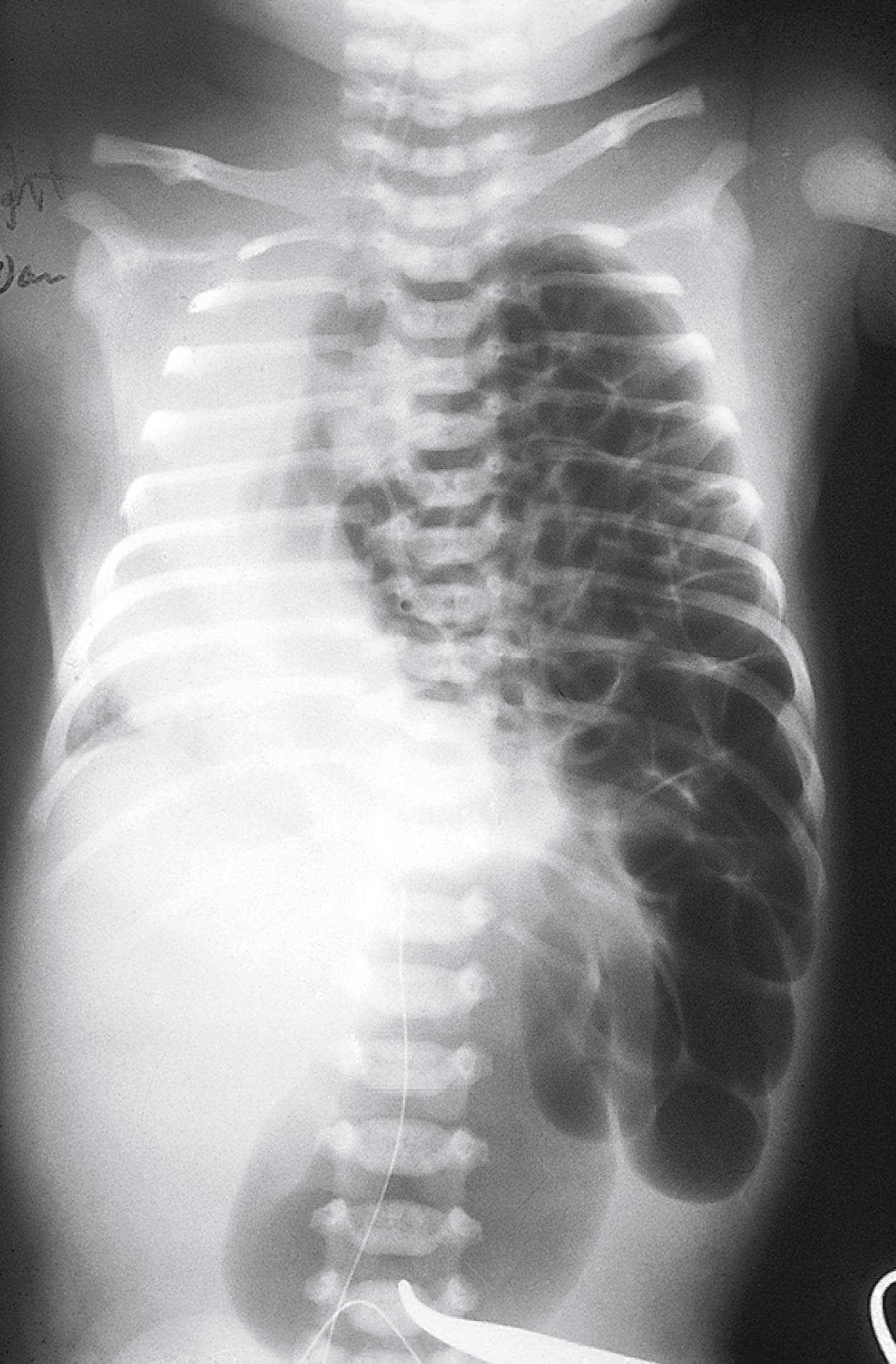 Fig. 18.22, Congenital diaphragmatic hernia allows intestines to enter the chest in utero.