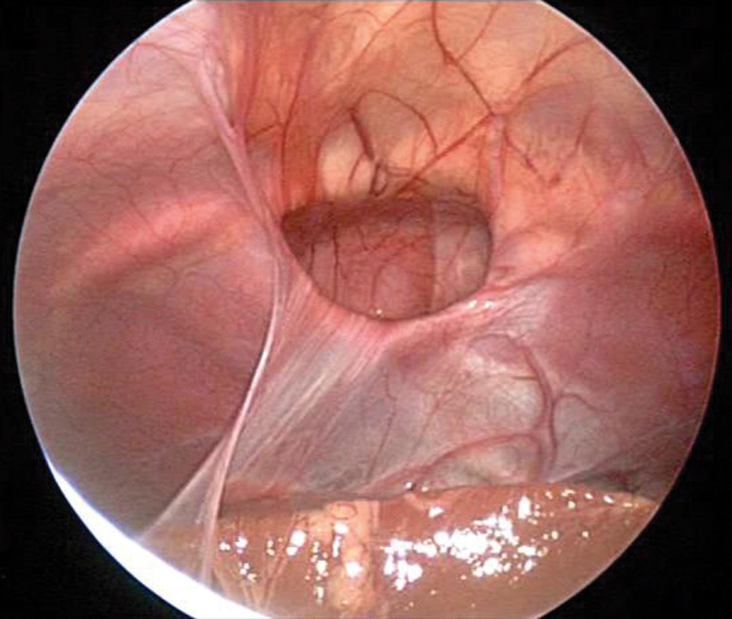 Fig. 18.23, A foramen of Morgagni hernia, seen here by laparoscopy as a central tendinous defect in the diaphragm, typically does not present as acute pulmonary distress in the newborn.