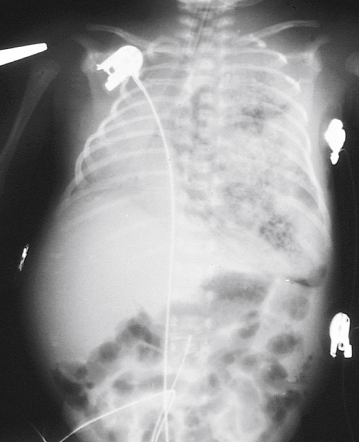 Fig. 18.24, Macrocystic adenomatoid malformation of the left lung. Large cystic lesions can be mistaken for bowel loops herniating through a diaphragmatic hernia.