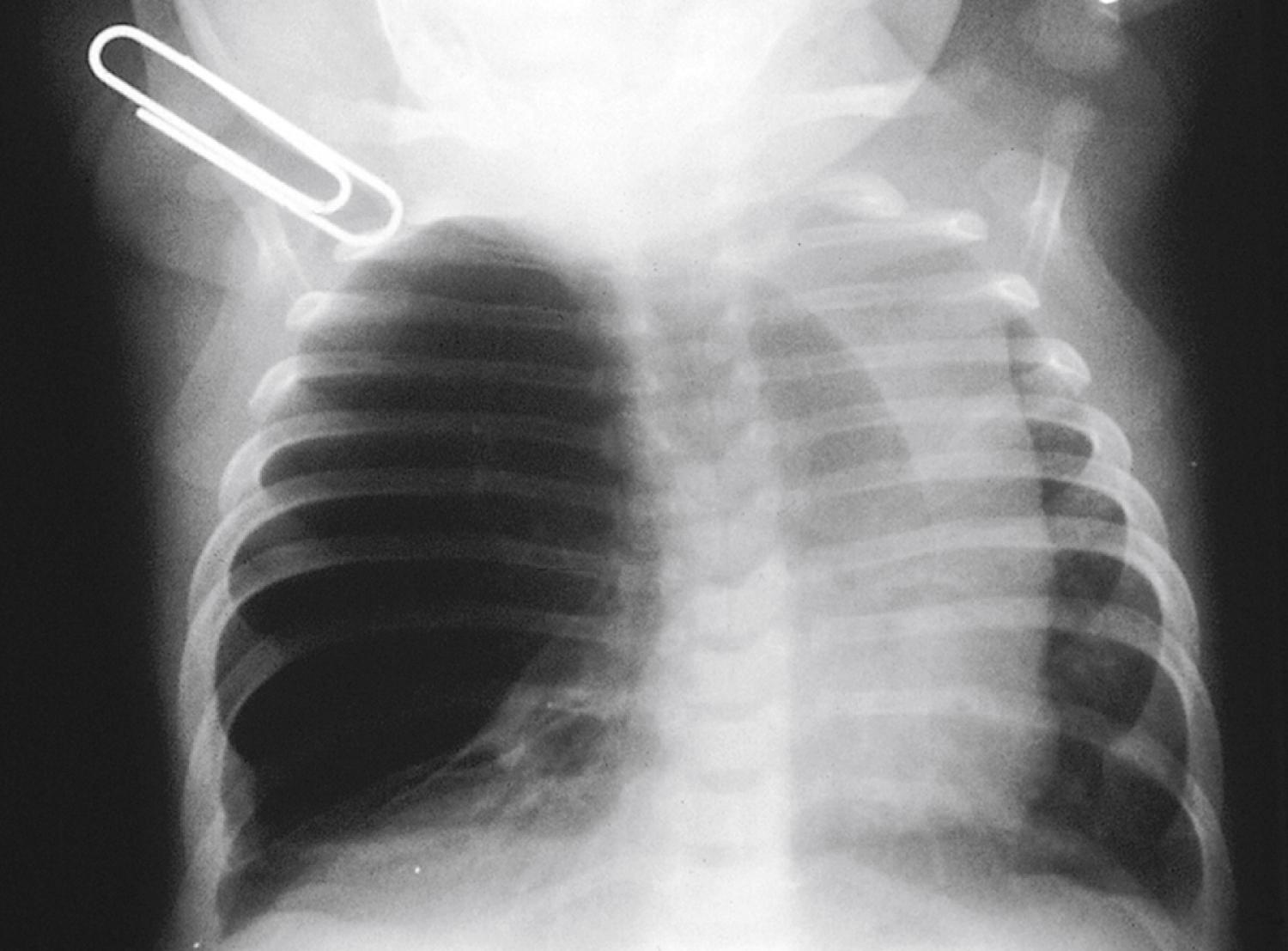 Fig. 18.25, Lobar emphysema, usually involving the upper lobes, may become hugely distended and may cause life-threatening respiratory distress.