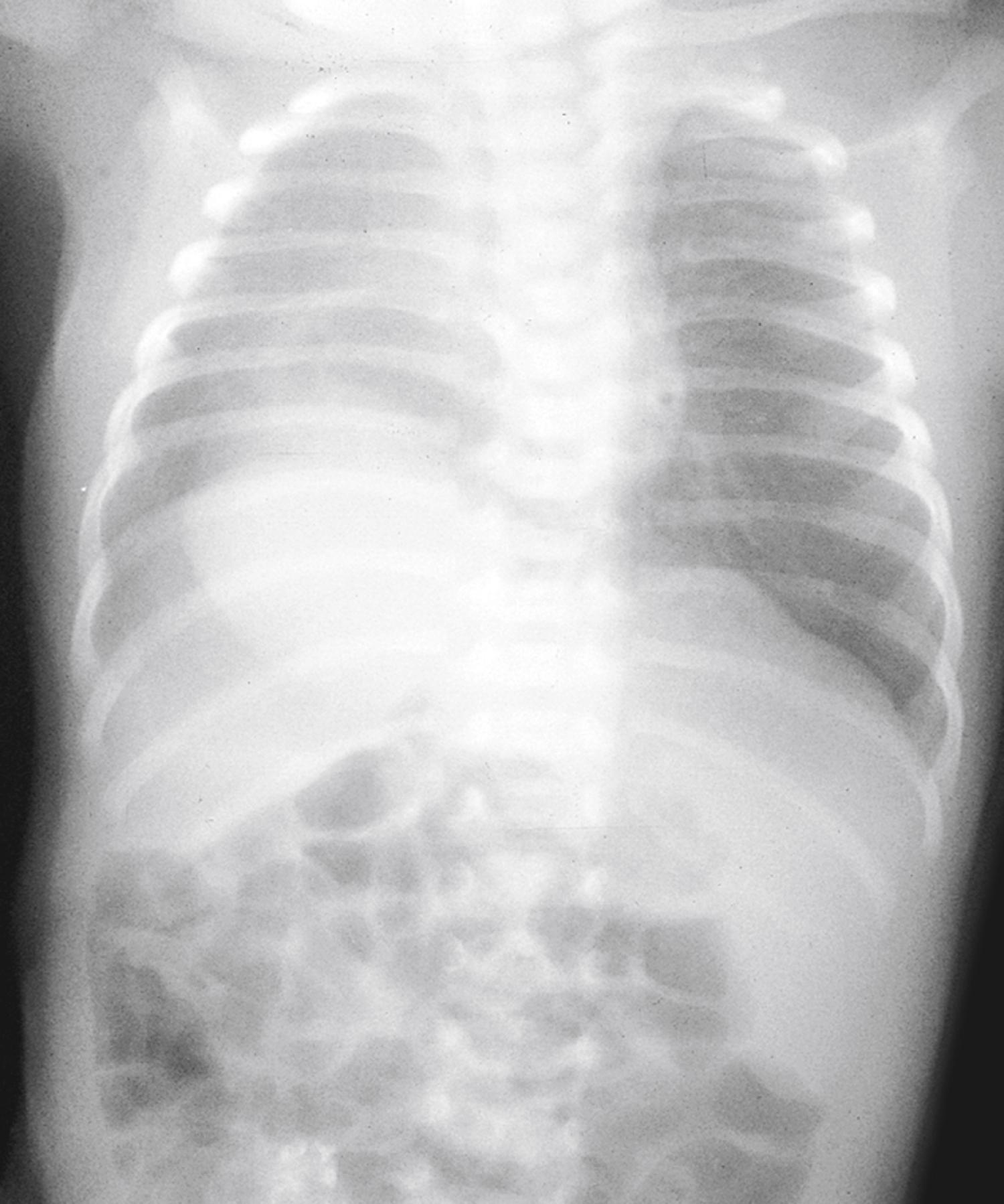 Fig. 18.26, Persistent infiltration of the lung parenchyma may indicate an intralobar sequestration, shown here involving the right lower lobe. Also shown is a right diaphragmatic hernia, a frequently associated malformation.