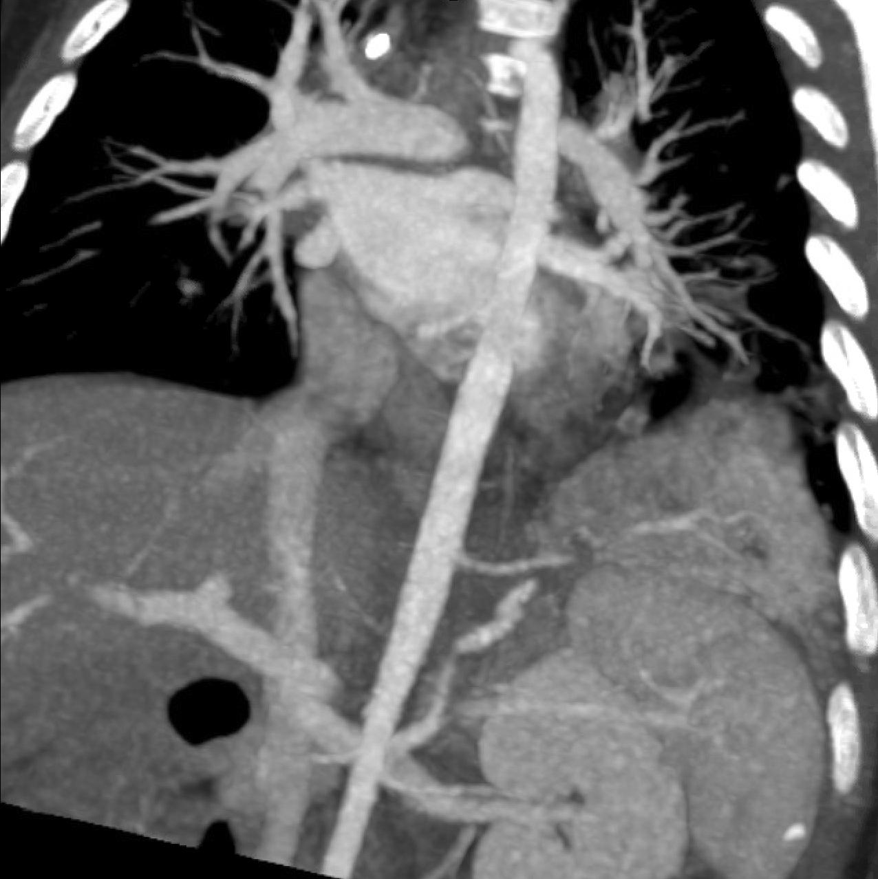 Fig. 18.27, Extralobar sequestrations are characterized by the presence of pulmonary parenchyma that lacks tracheobronchial communication and has a systemic blood supply. Computed tomography-angiogram shows systemic blood supply.