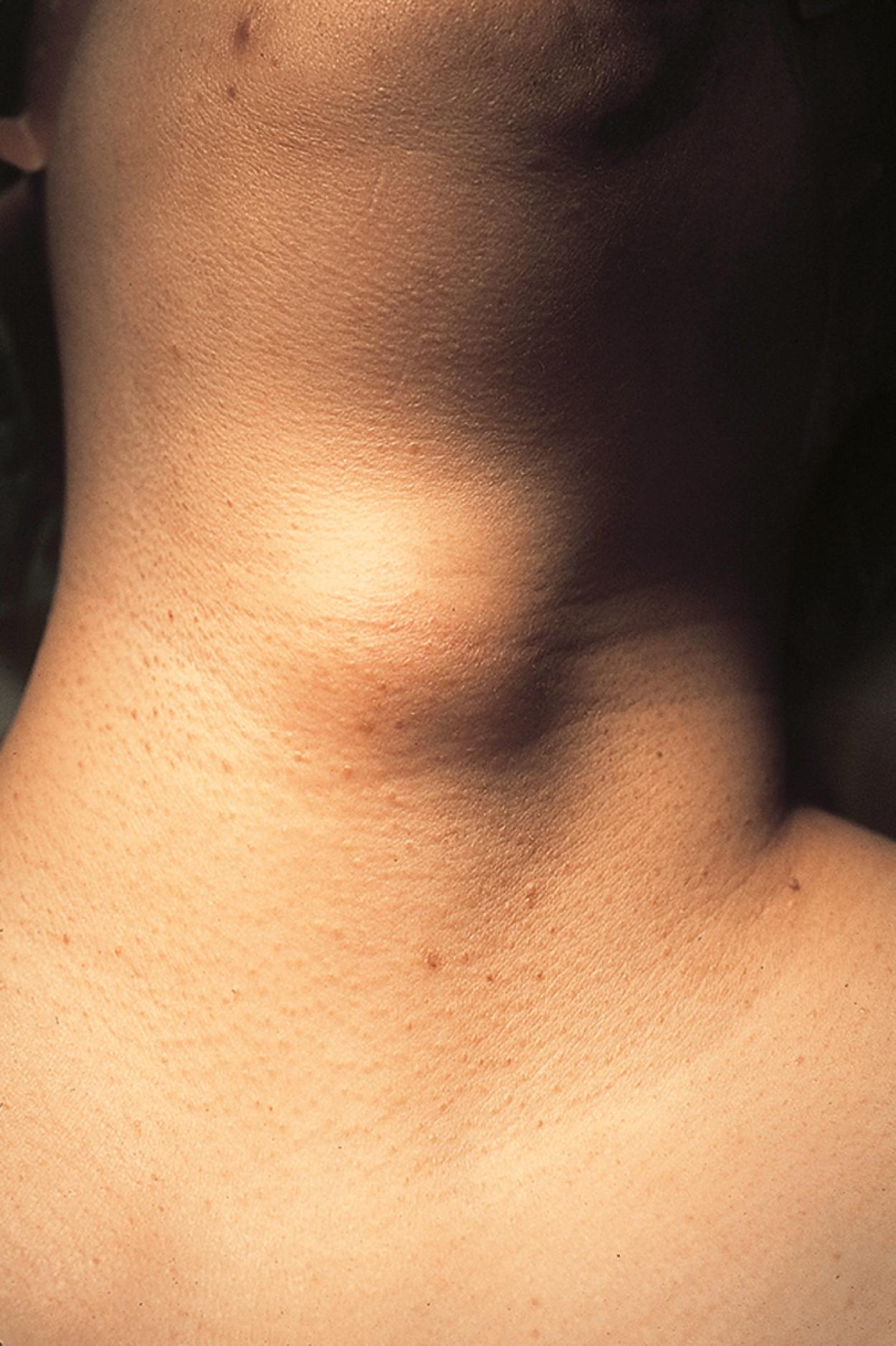 Fig. 18.4, Thyroglossal duct cyst produces a firm swelling in the midline of the neck. Its initial manifestation is sometimes a midline cervical abscess.