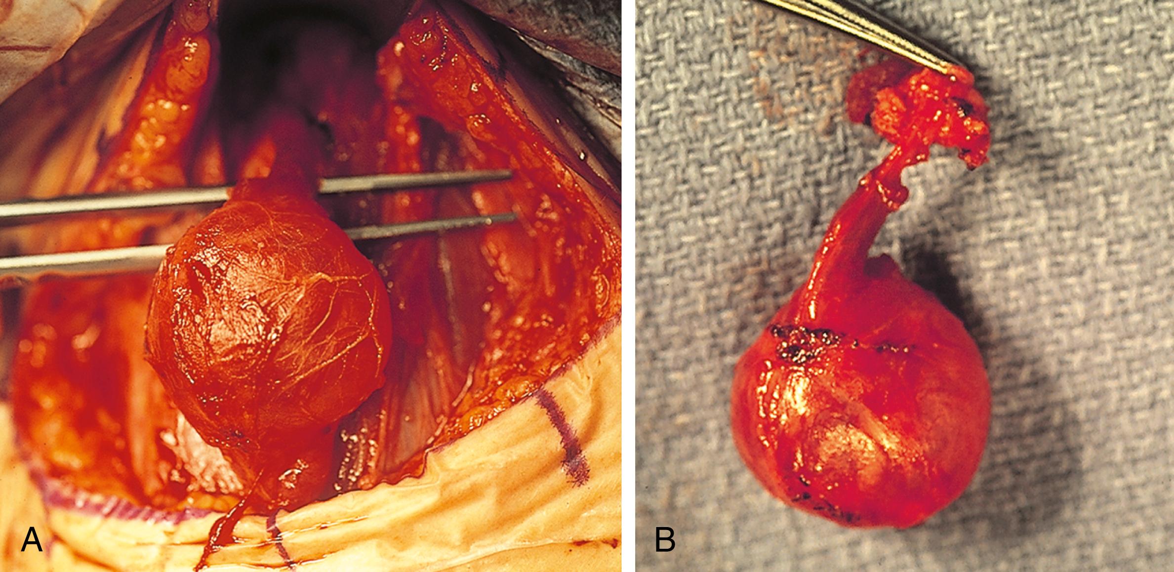 Fig. 18.5, The surgical specimen shows the thyroglossal duct as it courses from the lesion to the hyoid bone (the thicker transverse piece of tissue) (A). The hyoid must be resected to gain access to the tissue that extends to the base of the tongue (foramen cecum), which must be ligated to prevent recurrence (B).