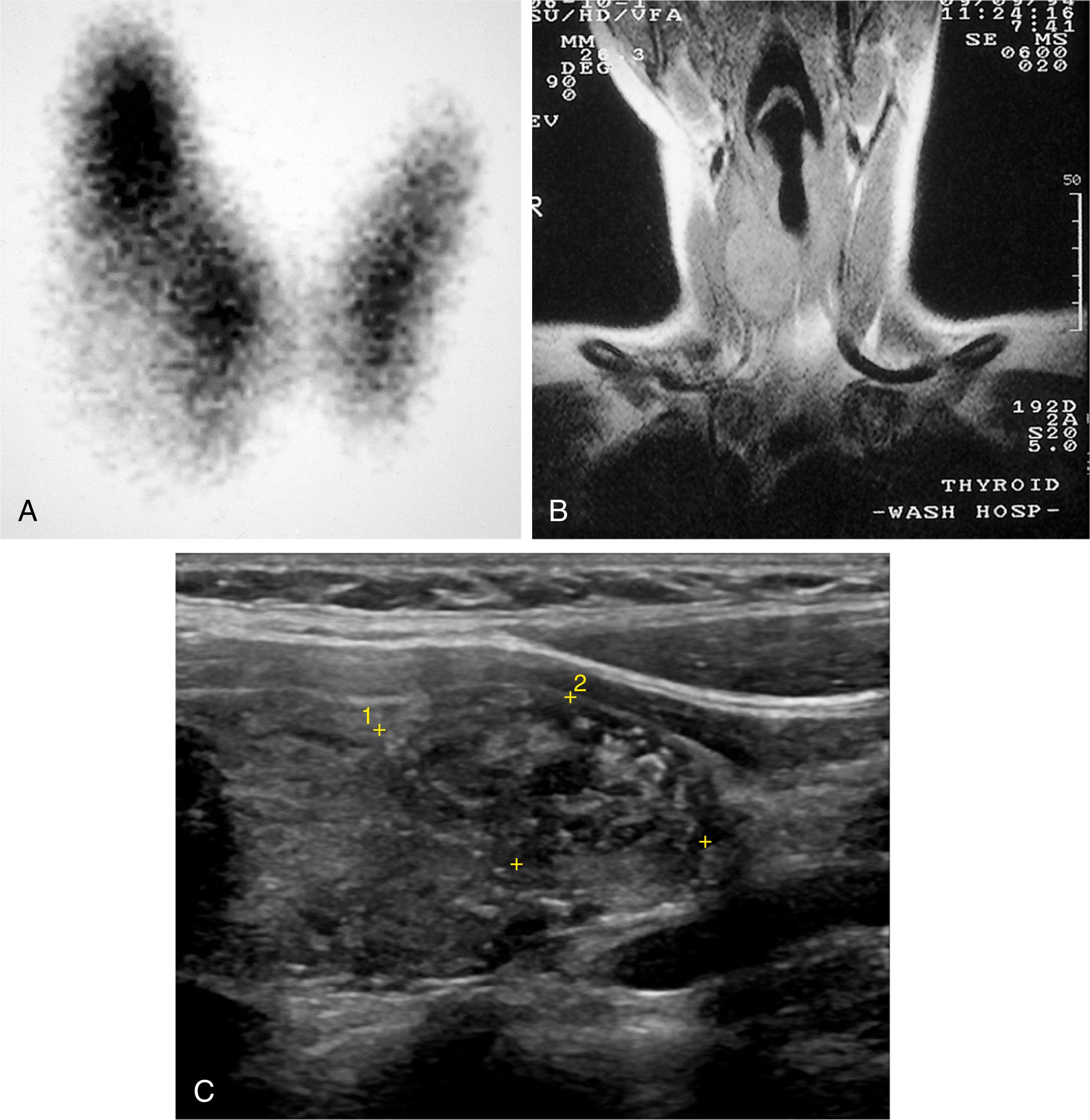 Fig. 18.6, Nonfunctioning or “cold” thyroid nodule visualized by thyroid scan (A) and magnetic resonance imaging (B) at surgery was found to be a benign follicular adenoma. Ultrasound demonstrating a TI-RADS 5 lesion (C), found to be papillary thyroid cancer.