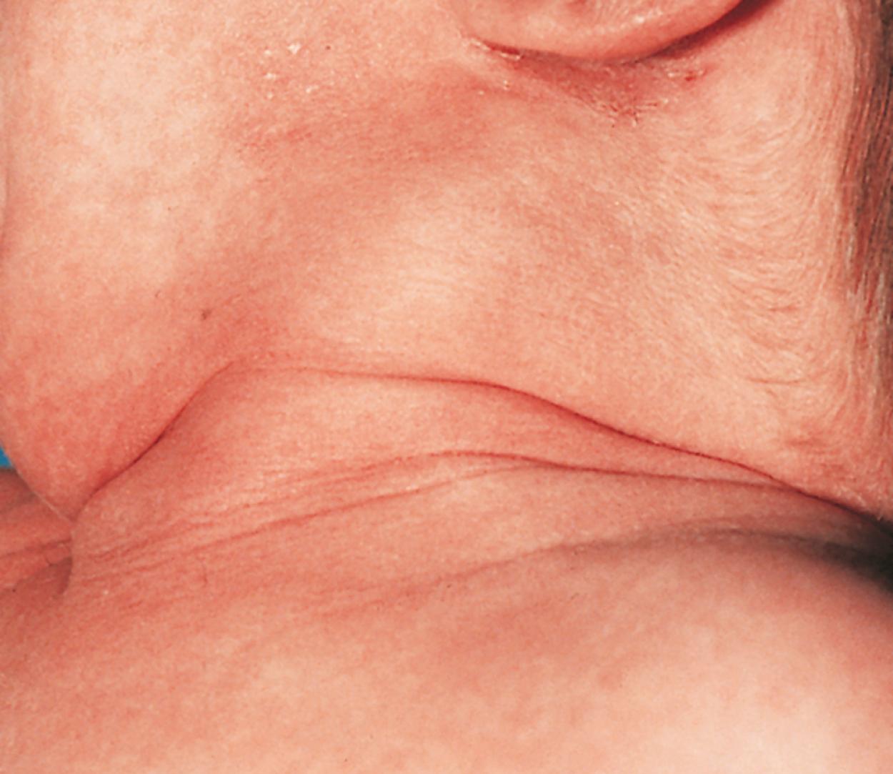 Fig. 18.8, The sternocleidomastoid in a newborn with torticollis may exist as a tight tendon-like cord or may swell and appear as a discrete tumor in the midportion of the muscle, pictured here.