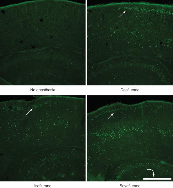 FIGURE 25.2, Prolonged exposure to anesthetics causes widespread apoptotic cell death in the developing animal brain. Representative photomicrographs of brain sections from 7- to 8-day-old mice exposed to 6 hours of equipotent doses of 7.4% desflurane , 1.5% isoflurane , 2.9% sevoflurane in 30% oxygen, respectively, or fasted, unanesthetized litter mates in room air ( no anesthesia ). These doses were previously determined to represent 0.6 minimum alveolar concentration for the respective anesthetics. Arrows mark clusters of cells in layer II/III of the neocortex that are dying from programmed cell death and are therefore labeled for the apoptotic marker, activated caspase 3 ( bright green ). Scale bar = 500 µm.