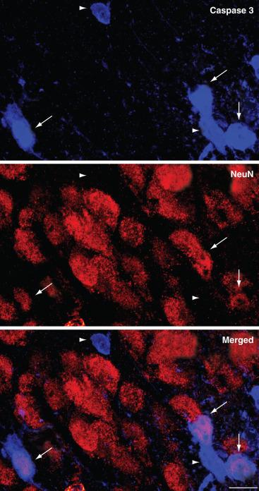 FIGURE 25.3, Neurons affected by apoptotic cell death following anesthetic exposure are surrounded by seemingly unaffected cells. Representative photomicrograph from a 7-day-old mouse following a 6-hour exposure to 1.5% isoflurane, showing neocortical cells stained for the apoptotic cell death marker activated caspase 3 ( blue , top ), the neuronal marker NeuN ( red , middle ), and a merged image of the two stains ( bottom ). The majority of dying cells are identified as postmitotic neurons, as indicated by the purple cells coexpressing activated caspase 3 and NeuN in the bottom ( arrows ), whereas some cells expressing caspase 3 are NeuN-negative ( arrowheads ). Importantly, cells affected by anesthetic-induced neuroapoptosis are surrounded by numerous, seemingly unaffected neurons. Scale bar = 10 µm.