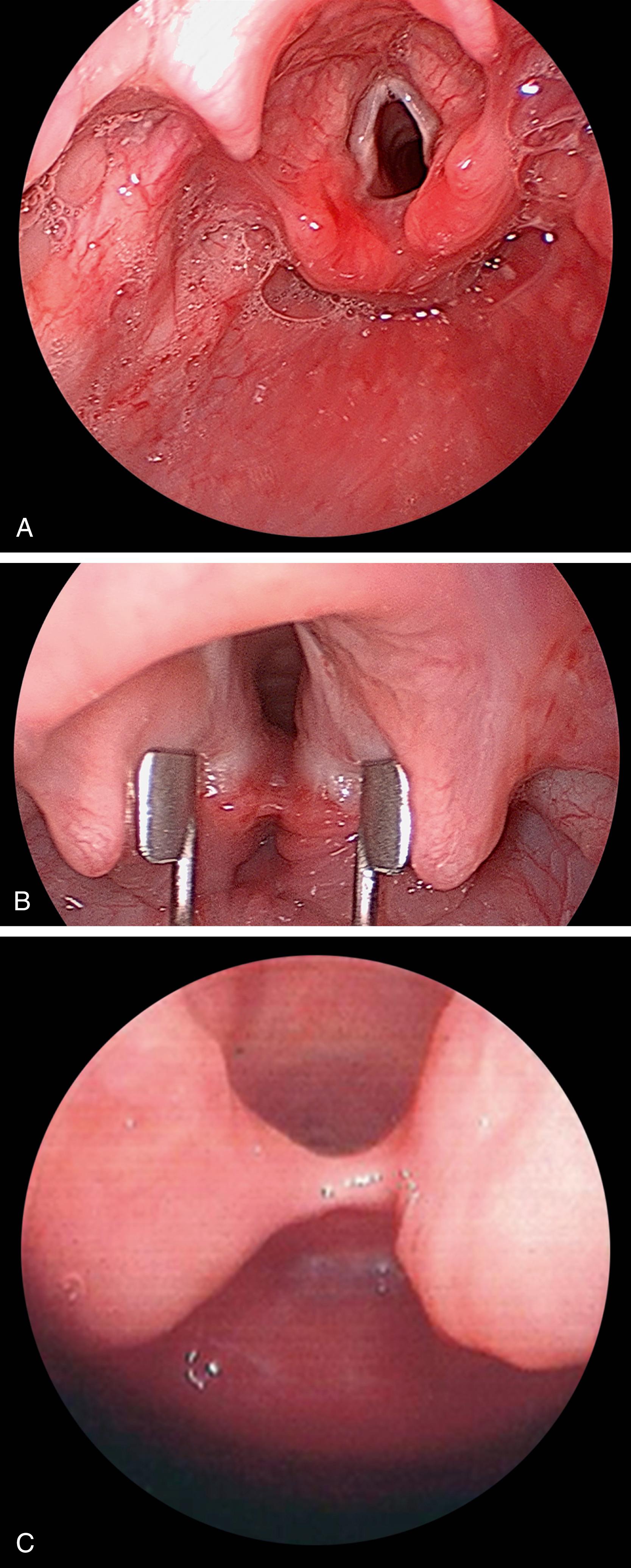 Fig. 195.1, Laryngeal cleft.