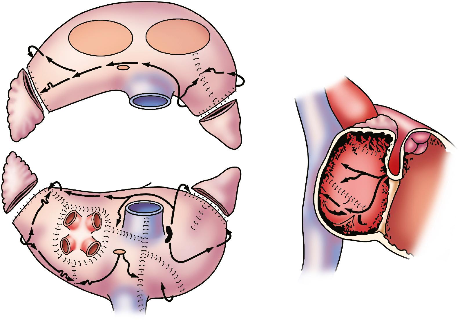 Fig. 135.1, Lesion set of the traditional cut-and-sew Cox-Maze III operation.