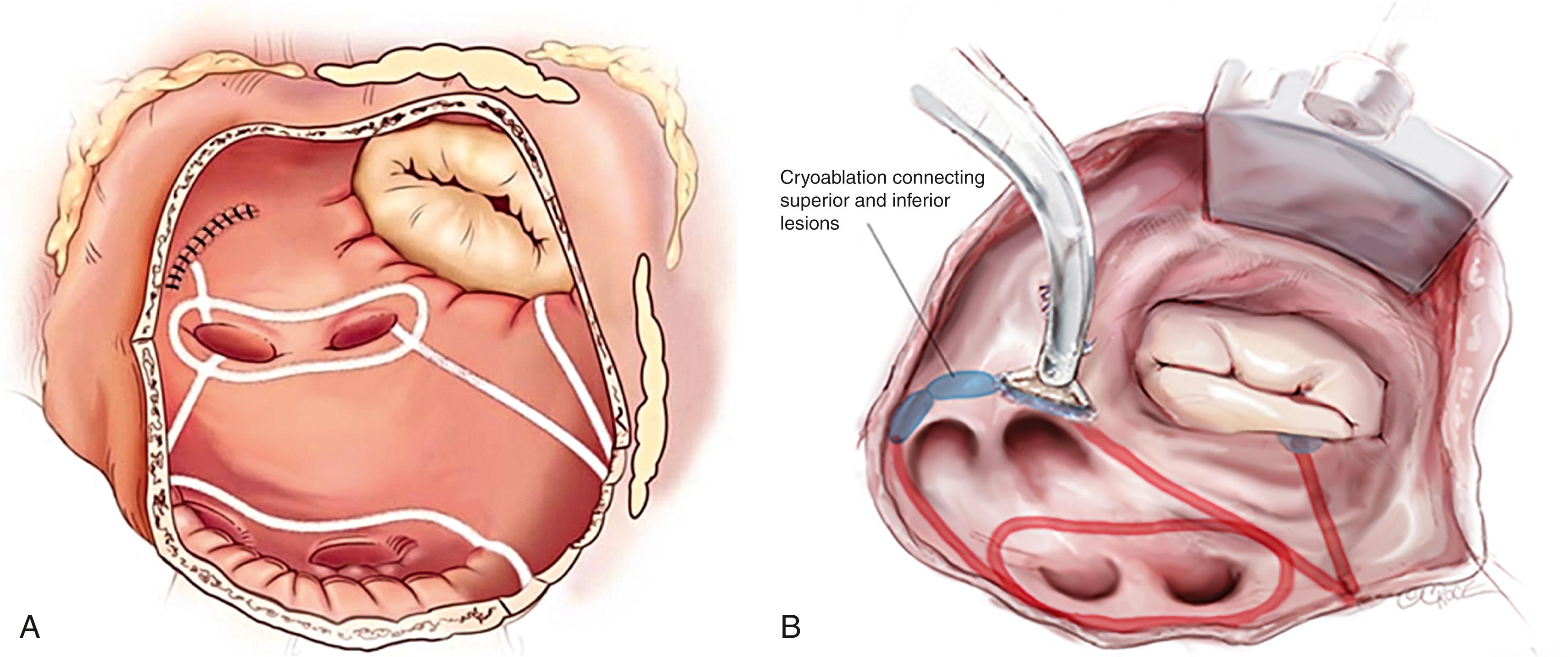 Fig. 135.4, Left atrial lesion set of the Cox-Maze IV via median sternotomy (A) and right minithoracotomy (B) approaches.