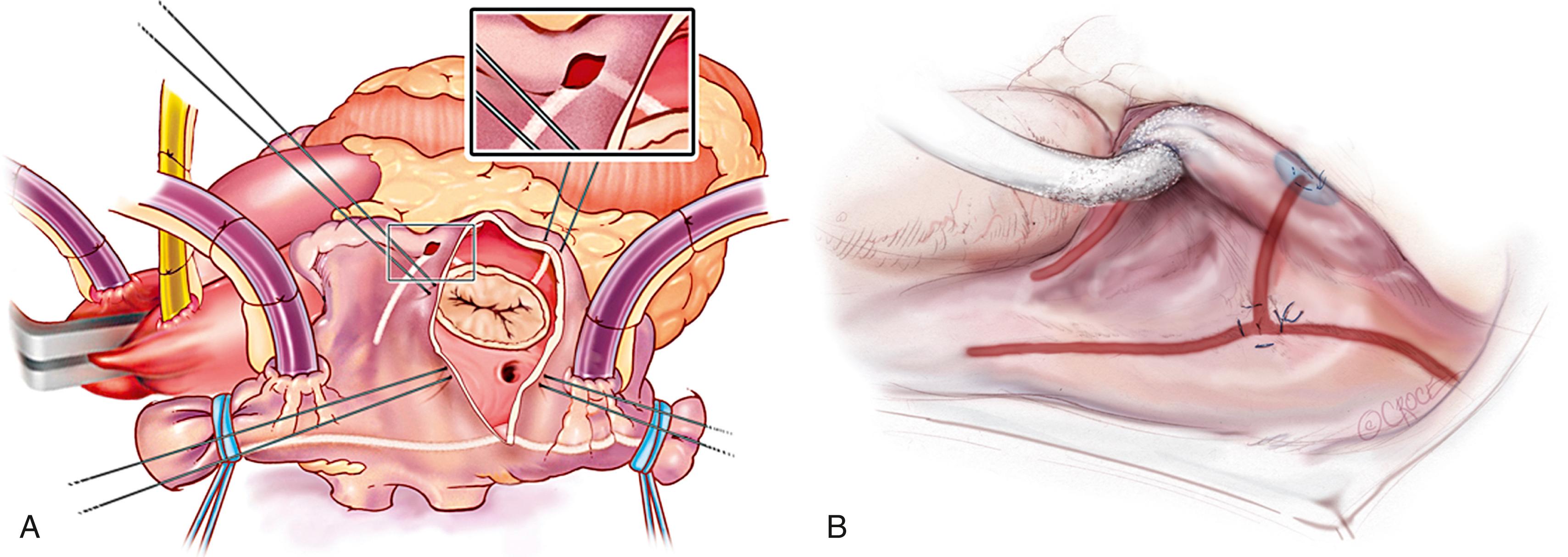 Fig. 135.5, Right atrial lesion set of the Cox-Maze IV via median sternotomy (A) and right minithoracotomy (B) approaches.