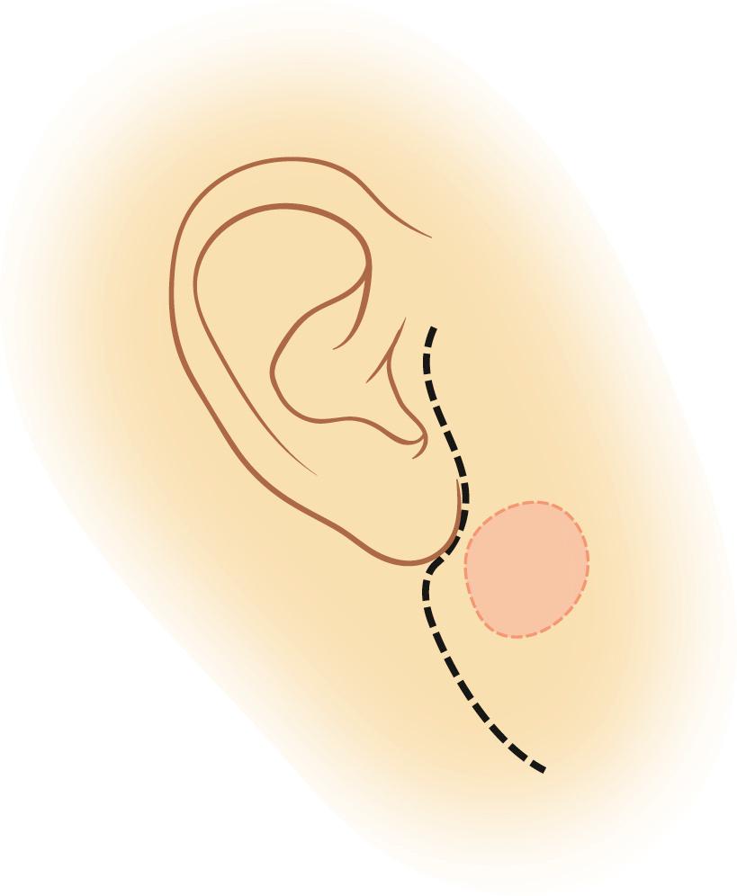 Fig. 35.1.1, Skin creases in the preauricular region and in the upper neck are used to mark the incision.