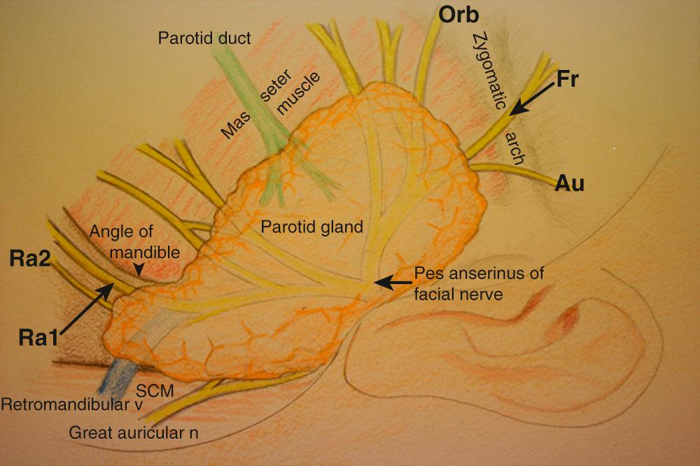 Fig. 35.1.11, Left parotid exposure for retrograde facial nerve dissection. Facial nerve branches: Fr, frontal branch exposed distally over zygomatic arch; Ra1, ramus mandibularis superficial branch exposed just inferior and posterior to angle of mandible; Ra2, ramus mandibularis deep branch, note variant passing deep to retromandibular vein proximally; Orb, orbicular oculi branch; Au, auricular muscle branch. Note the parotid duct situated between the superior and inferior divisions of the facial nerve.
