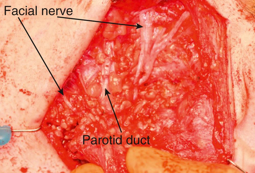 Fig. 35.1.13, Left parotidectomy using retrograde facial nerve dissection, tumor grasped between fingers, showing the parotid duct between the superior and inferior divisions of the facial nerve.
