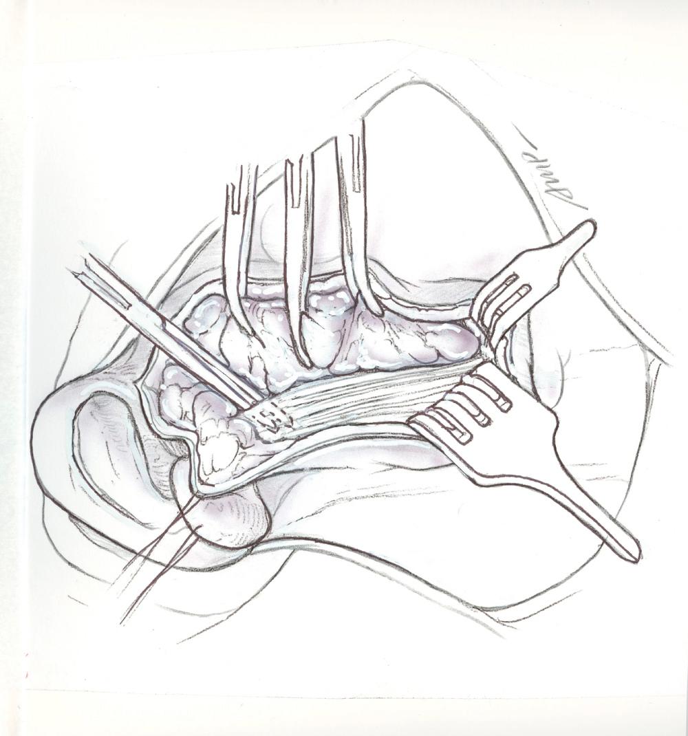 Fig. 35.1.3, Anterior border of the sternocleidomastoid muscle dissection.