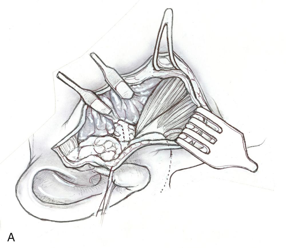 Fig. 35.1.5, Posterior belly of the digastric muscle being displayed after dissection of the parotid gland from sternocleidomastoid muscle.