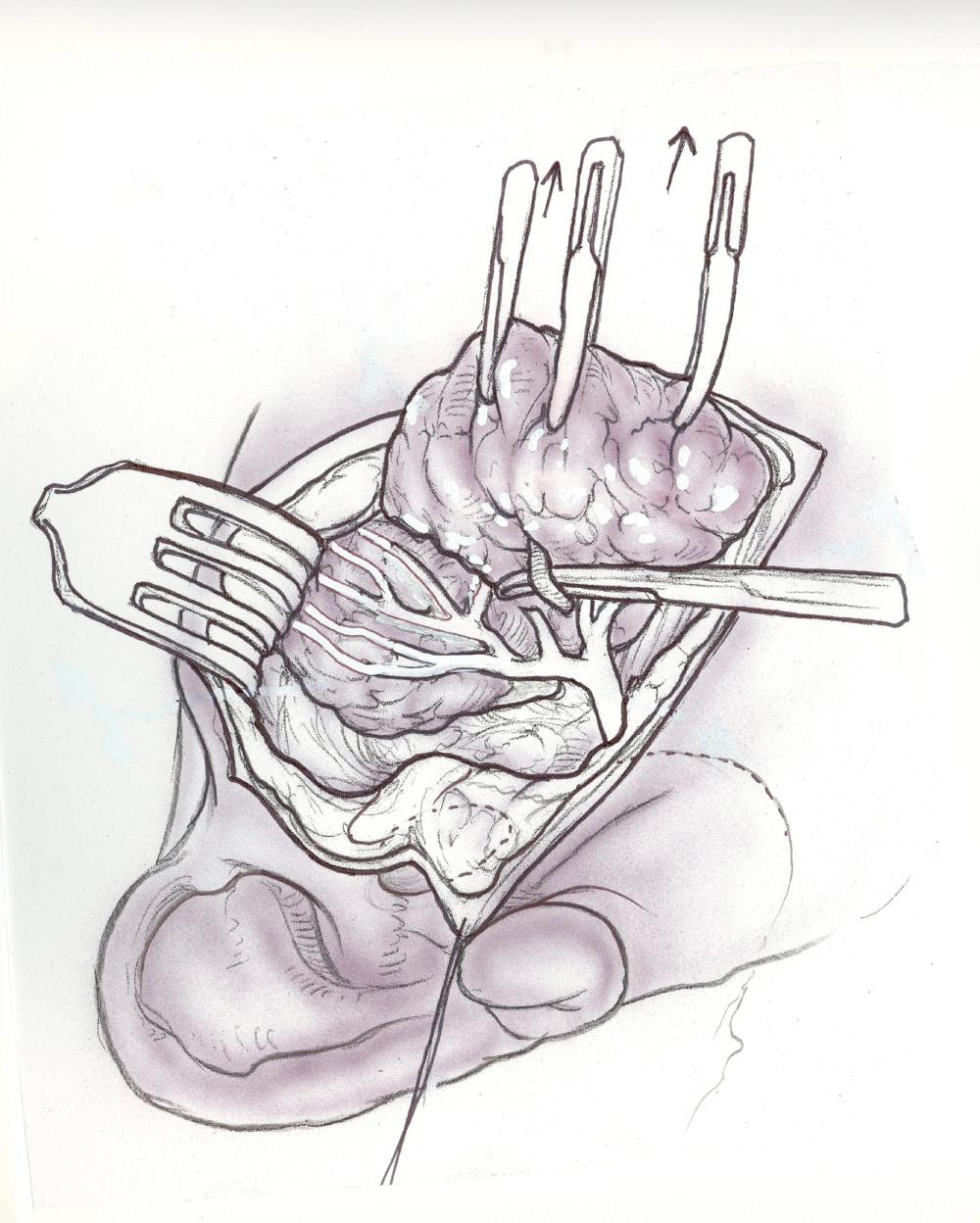 Fig. 35.1.8, Stensen's duct identification.