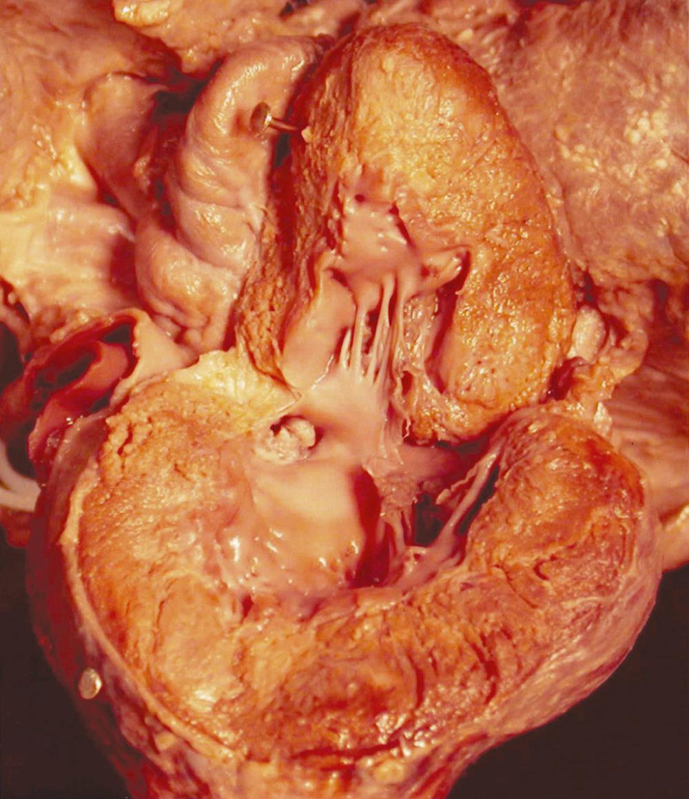 FIGURE 123-2, Pathologic specimen showing aortic stenosis in the neonatal heart.