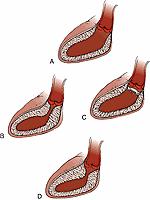 FIGURE 123-3, Examples of forms of (A) fixed aortic stenosis, (B) discrete membrane, (C) tunnel-like stenosis, and (D) muscular obstruction.