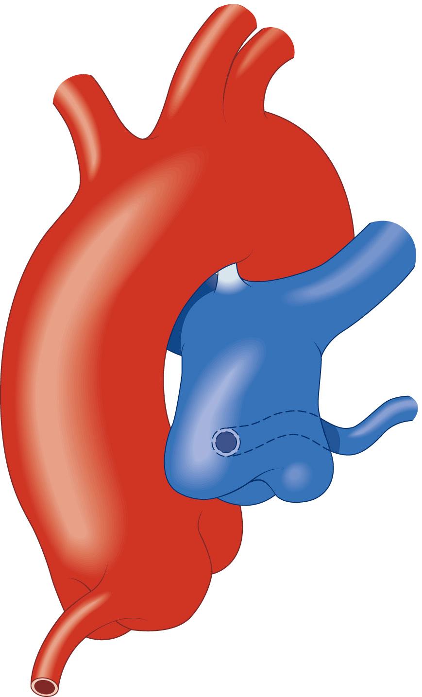 FIGURE 124-1, The aorta and pulmonary artery showing anomalous origin of the left main coronary artery from the posterior-facing sinus of the pulmonary artery with the anomalous artery coursing behind the pulmonary artery.