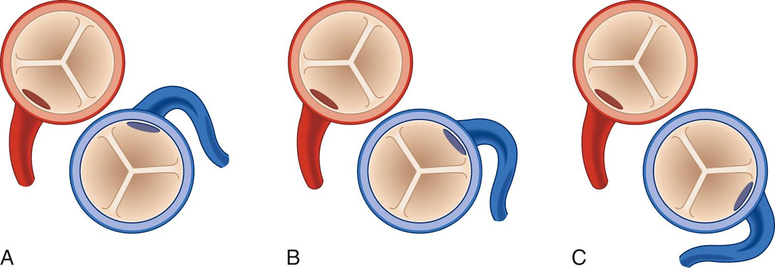 FIGURE 124-2, A, Anomalous origin of the left main coronary artery from the rightward aspect of the posterior-facing sinus of the pulmonary artery. B, Anomalous origin of the left main coronary artery from the leftward aspect of the posterior-facing sinus. C, Anomalous origin of the left main coronary artery from the nonfacing sinus of the pulmonary artery.