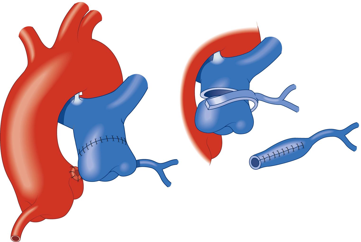 FIGURE 124-4, Occasionally when the coronary artery arises from the leftward or anterior aspect of the pulmonary artery, direct reimplantation may not be possible. In these situations, a tube can be constructed from a segment of pulmonary artery to lengthen the coronary and allow reimplantation on the aorta.