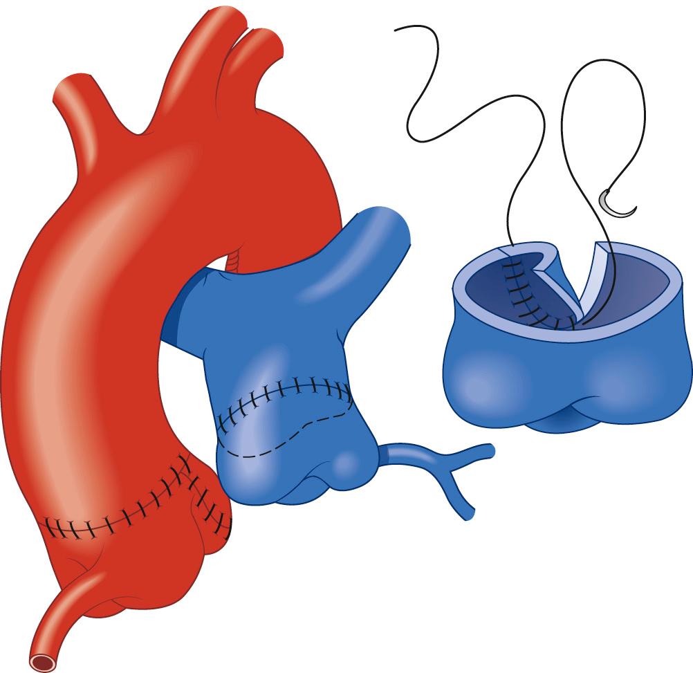 FIGURE 124-6, After the coronary is reimplanted, the aorta is closed primarily. The pulmonary artery may often be closed primarily. Ligation and division of the ligamentum arteriosus improves mobility of pulmonary artery. Occasionally, patch repair of the defect in the pulmonary artery with autologous pericardium may be necessary (inset) .