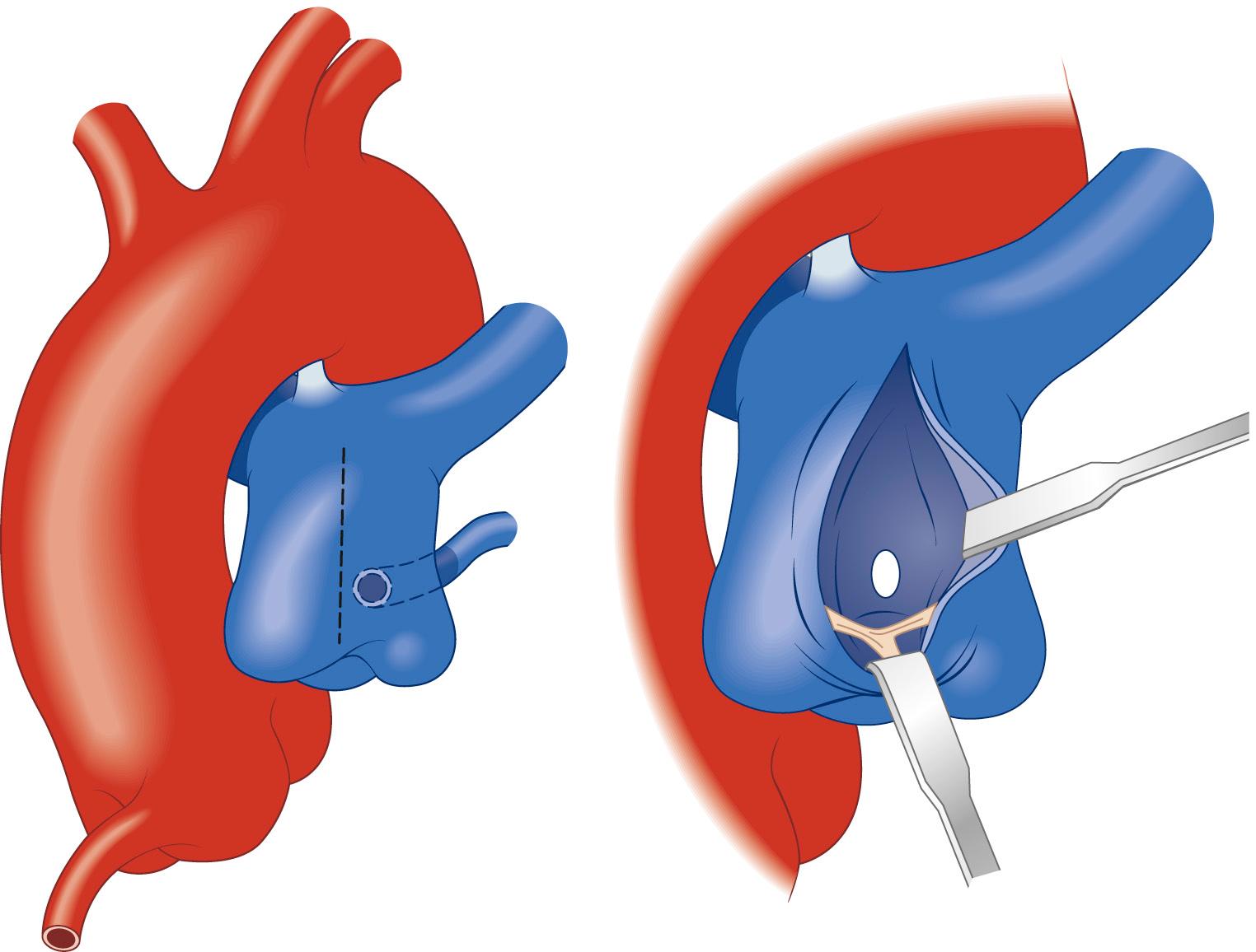 FIGURE 124-7, After institution of cardiopulmonary bypass and induction of cardioplegia, a longitudinal incision is made in the main pulmonary artery, and the ostium of the abnormal coronary is identified.